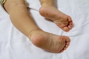Hand, Foot and Mouth disease in children, hand foot and mouth disease on foot