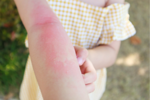 Rashes in children, Pediatric Center