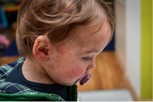 Measles in Children, Pediatric Center
