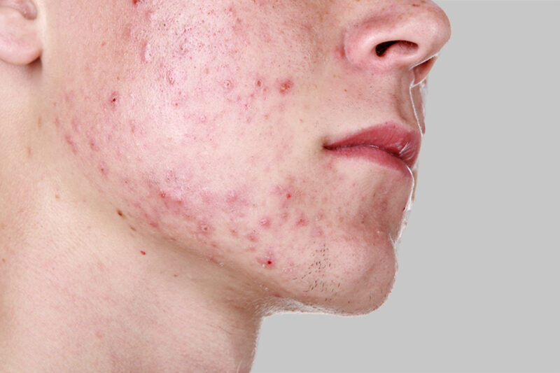 Acne in Children - Pediatric Center