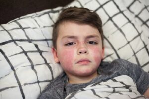 Scarlet Fever in Children, Pediatric Center